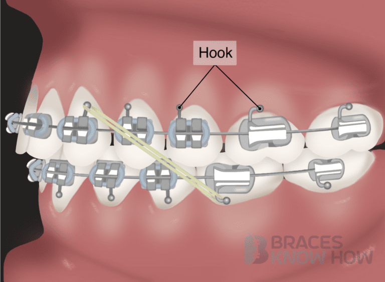 Why Do Braces Have Hooks? Types of Hooks Explained