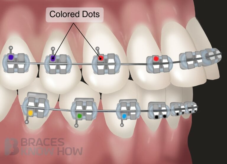 Colored Dots on Braces – What Are They, Do They Come Off?