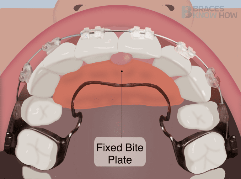 Is Your Bite Plate Loose? How to Check for Damage