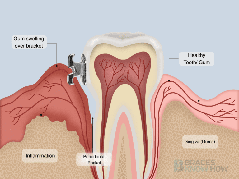 What Causes Gums to Grow Over Braces? Prevention Is Key