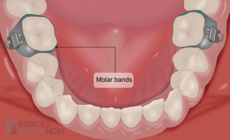 Are Molar Bands Necessary? Here’s Why You May Need Them
