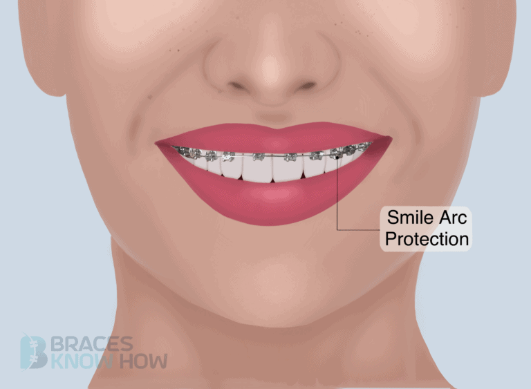 Why Are Your Braces So High Up? Learn About This Technique