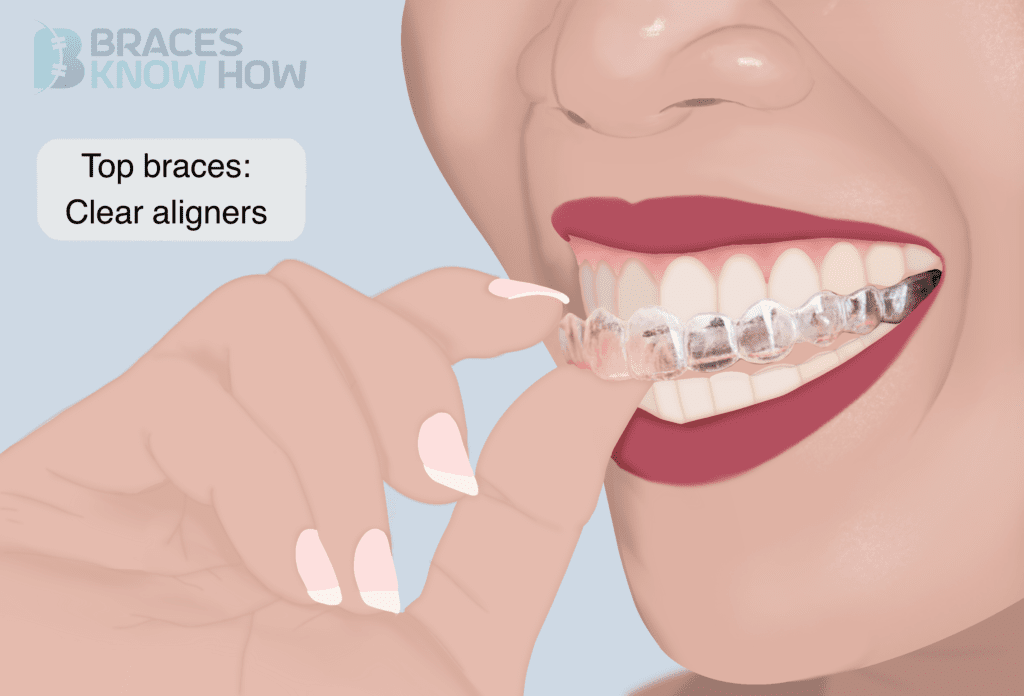 Illustration showing woman with top clear aligner. Top braces only. 