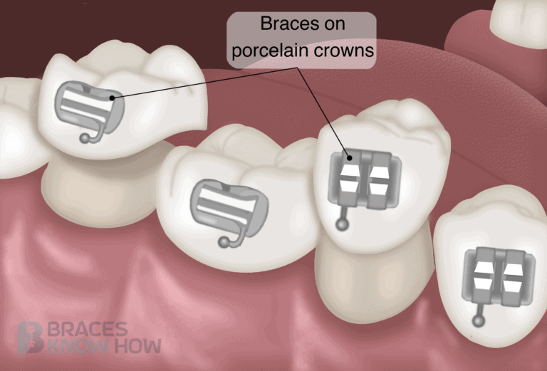 Can You Get Braces if You Have Crowns? What to Expect