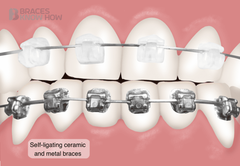 9 Facts About Self-Ligating Braces. Are They Right for You?