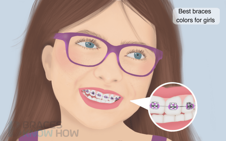Braces Colors for Girls: Top Picks to Brighten Your Smile