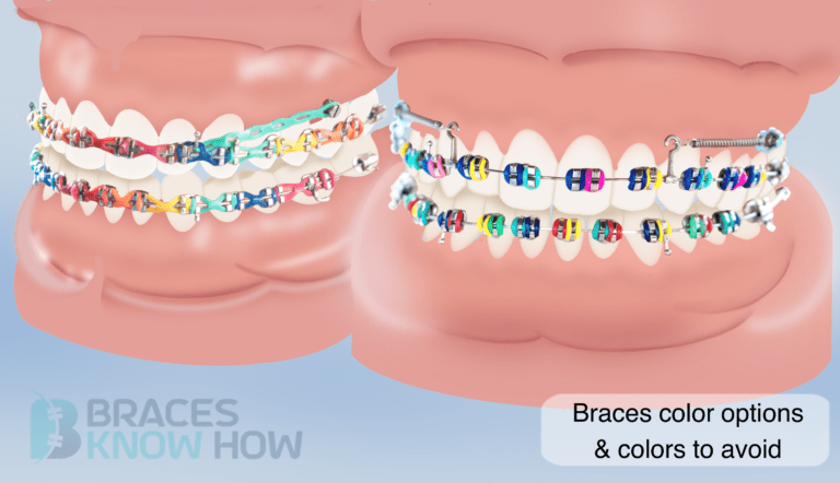 What Braces Colors Should You Avoid? Some Might Surprise You