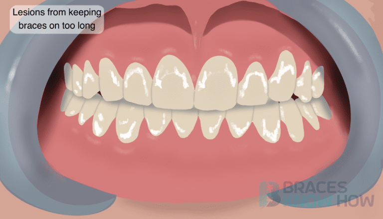 What Happens if Braces Stay On Too Long? When to Worry