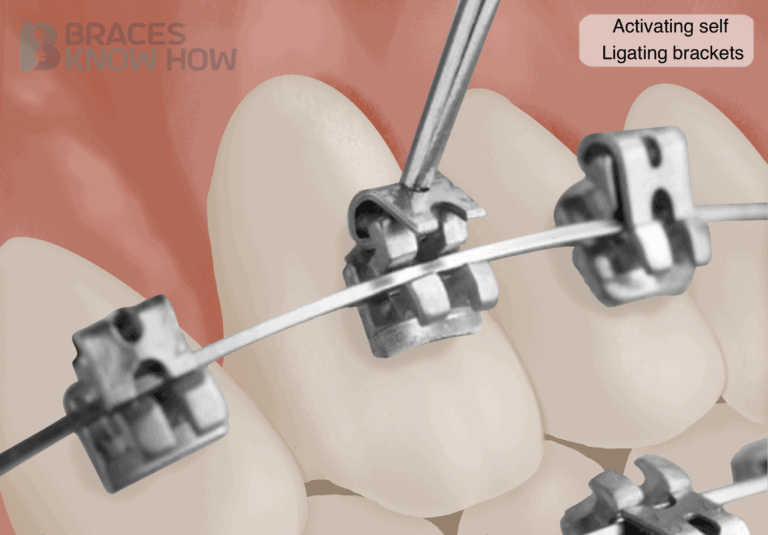 How Are Self-Ligating Braces Tightened? Explained Simply