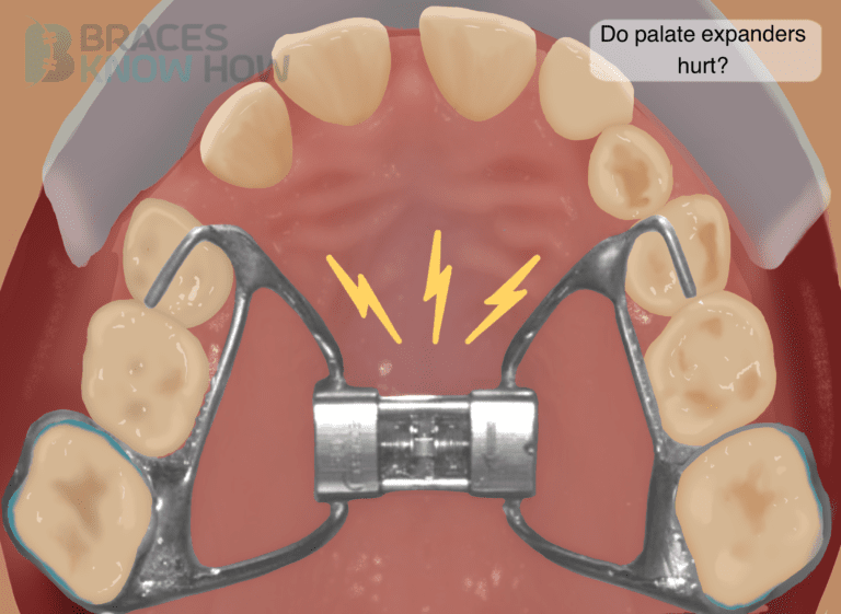Do Palate Expanders Hurt? What’s Normal and What’s Not