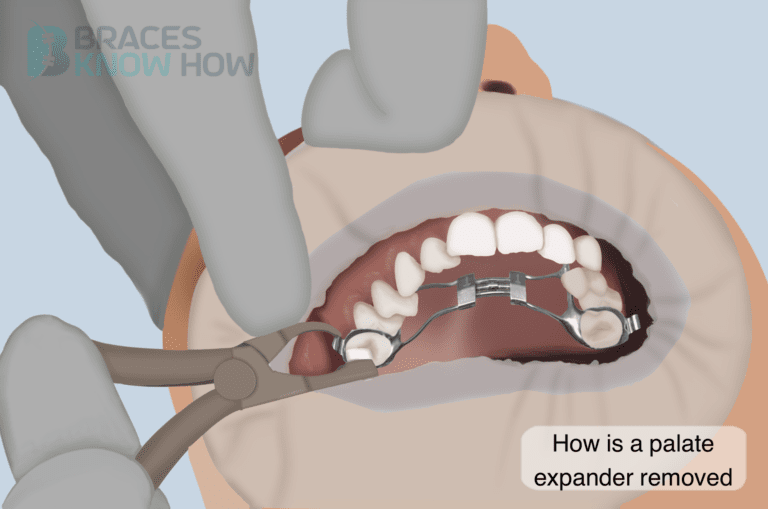 How Is a Palate Expander Removed? All You Need to Know
