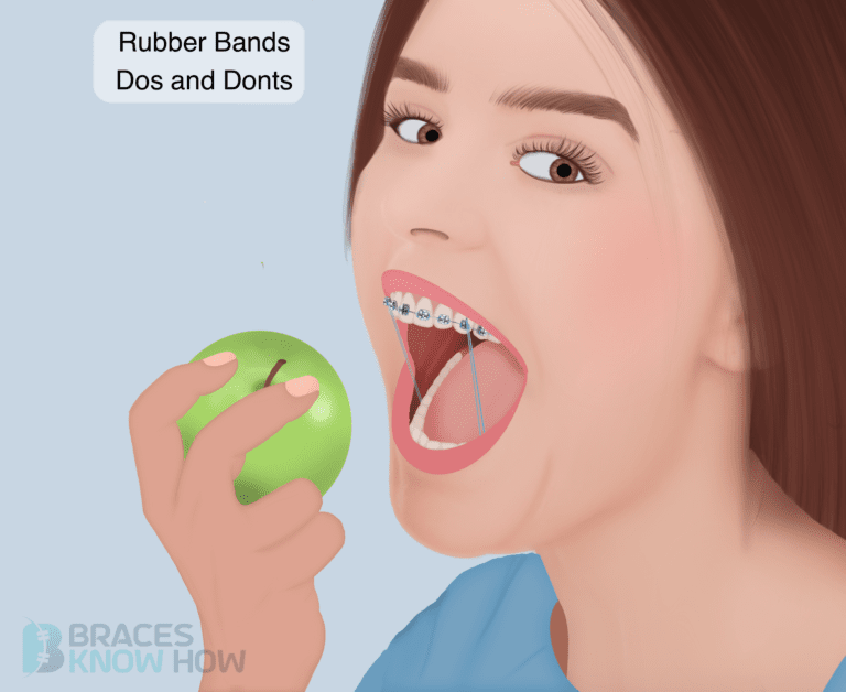 10 Braces Rubber Bands DOs and DON’Ts