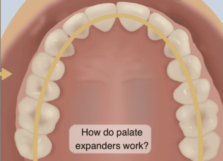 How Do Palate Expanders Work? All Your Questions Answered