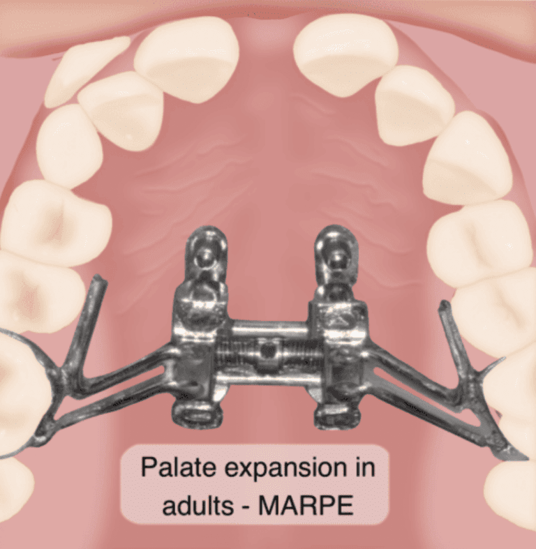 Can You Be Too Old for a Palate Expander? MARPE Explained
