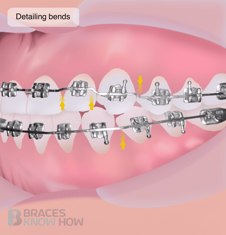 Why Did My Orthodontist Twist My Wire? All About Wire Bends
