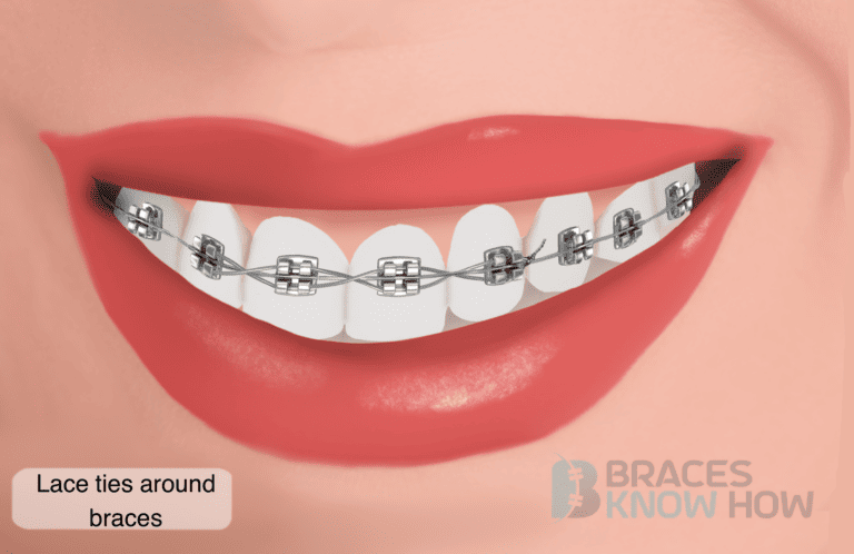 What’s That Twisted Wire Around Braces? Lace Ties Explained