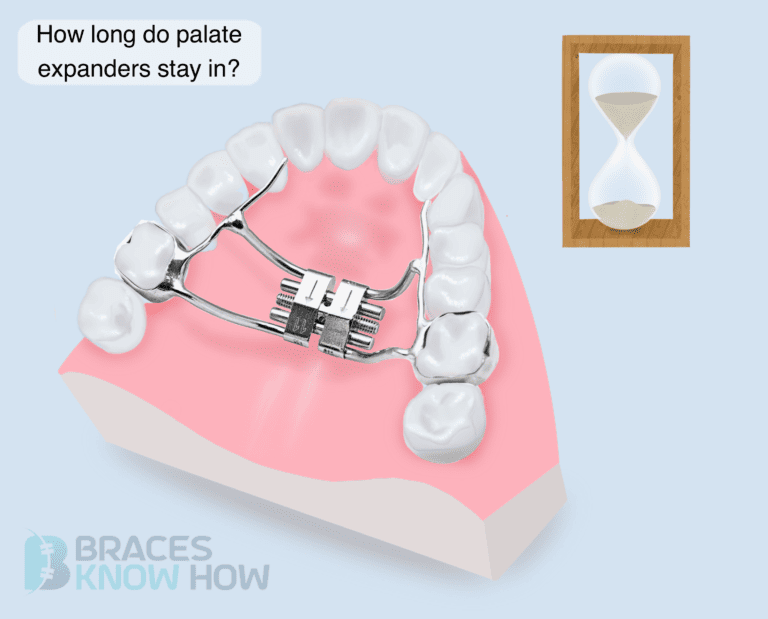 How Long Do Palate Expanders Stay In? We Have the Answer