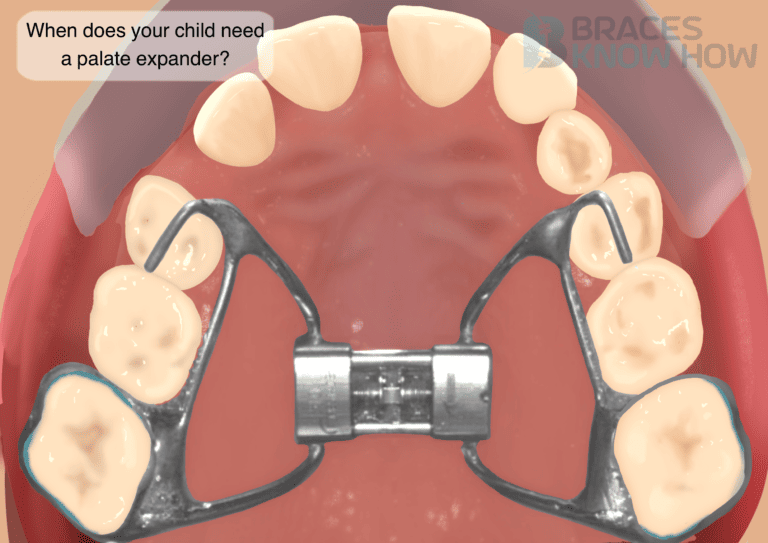 When Does Your Child Need a Palate Expander? Expert Advice