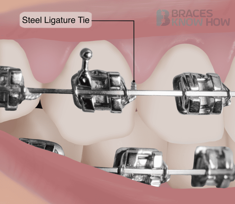 What Do Steel Tie Ligatures Do in Braces? Expert Tips