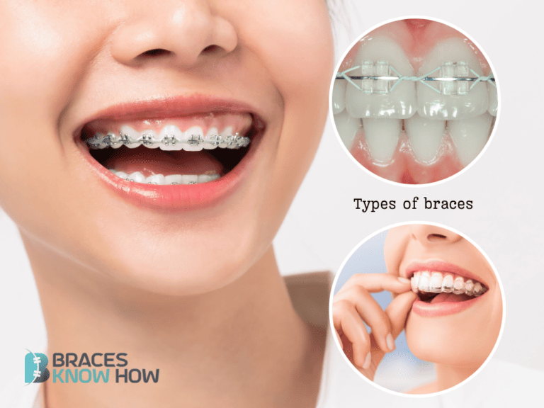 Types of Braces: Exploring Orthodontic Treatment Options