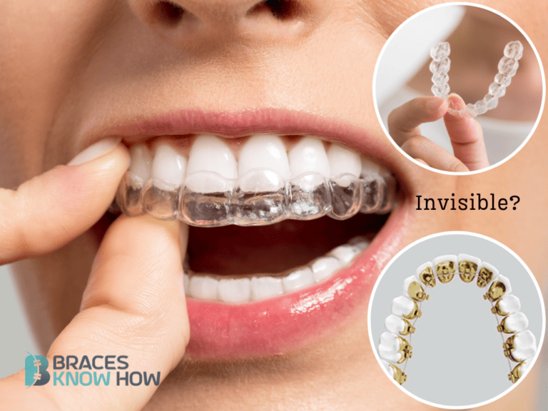 Invisible Braces: What They Are & Different Types Explained