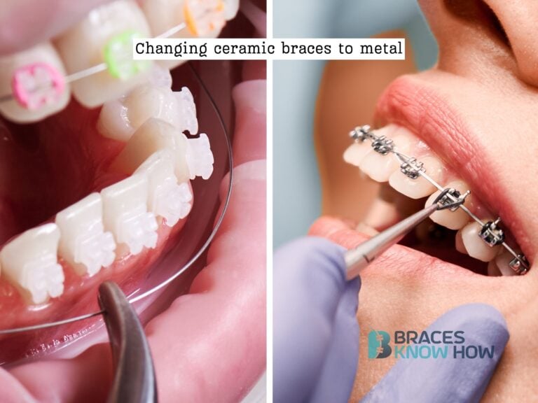 Can You Change Ceramic Braces to Metal? Here’s the Process