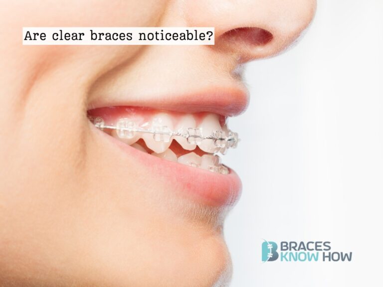 Are Clear Braces Noticeable? How to Keep Them Pristine