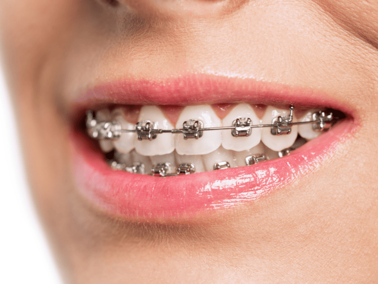 Self-Ligating Braces Explained: Are They Better?