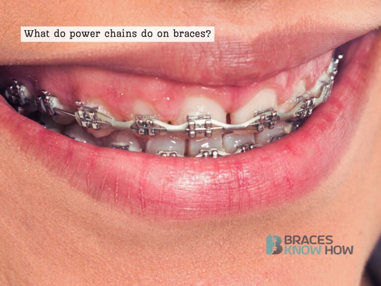 What Is the Purpose of Power Chains on Braces?